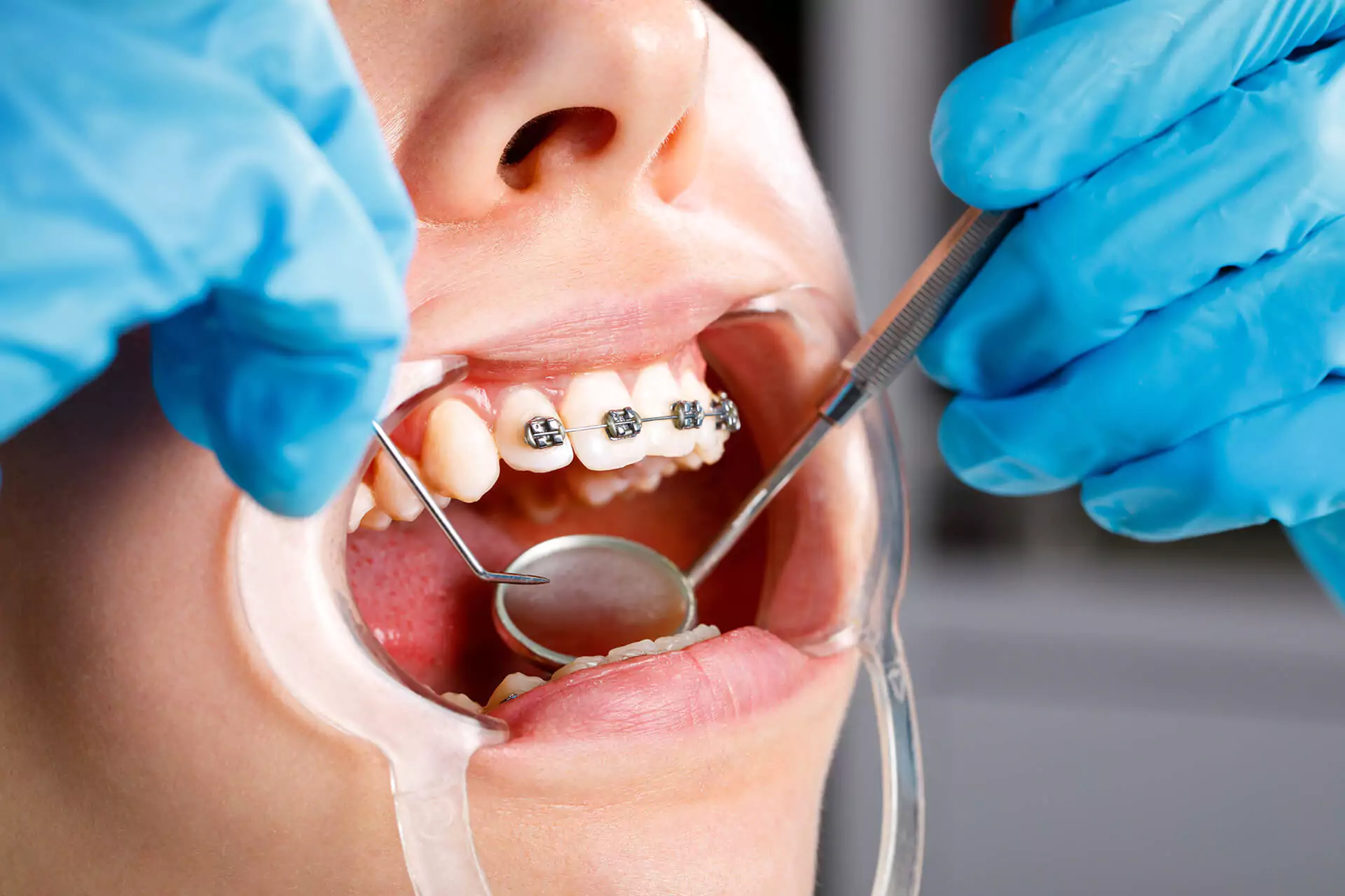 Root Canal Treatment